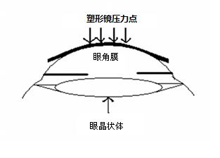 角膜塑形用硬性透氣接觸鏡說明書編寫指導(dǎo)原則（2020年修訂版）（2020年第47號）(圖1)