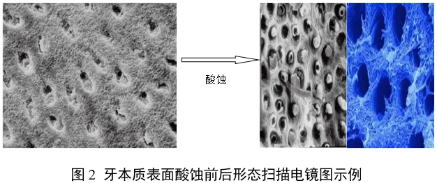 牙科用磷酸酸蝕劑注冊審查指導原則(2022年第41號)(圖2) 牙科用磷酸酸蝕劑注冊審查指導原則(2022年第41號)(圖2)